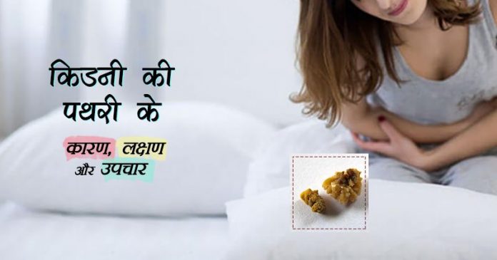 pathri ka ilaj stone remedies treatment in hindi