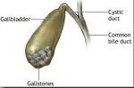 Natural Remedies for Gall Bladder Stones(1) (1)
