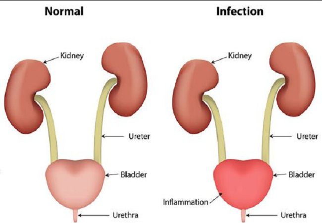 Urinary-Tract-Infection-UTI