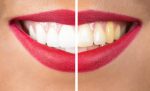 teeth-before-and-after-
