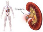 kidney-stone-1