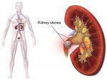 kidney-stone-1