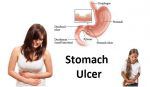 stomach-ulcer